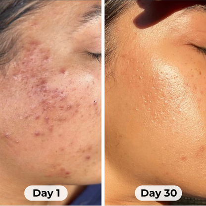 Theraloom Acne Mask 2.0