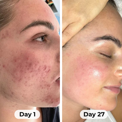 Theraloom Acne Mask 2.0