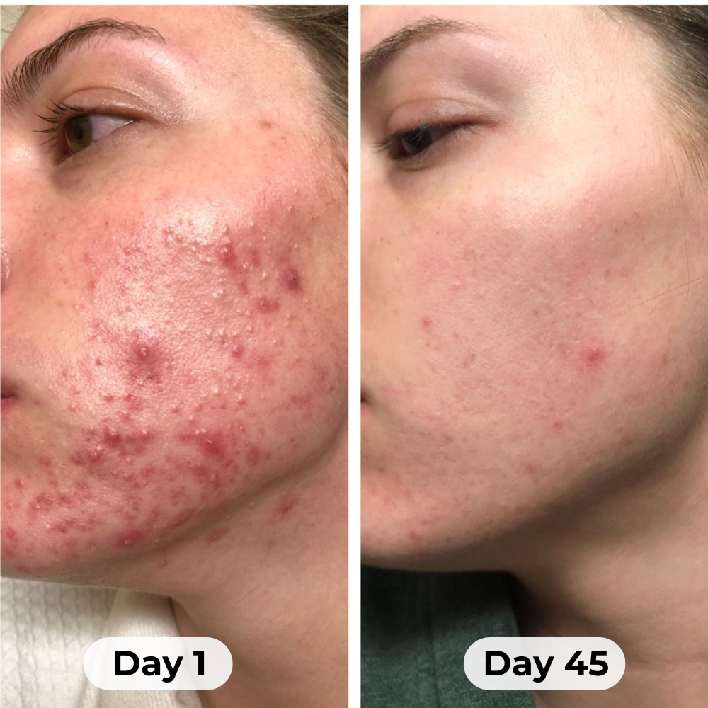 Theraloom Acne Mask 2.0