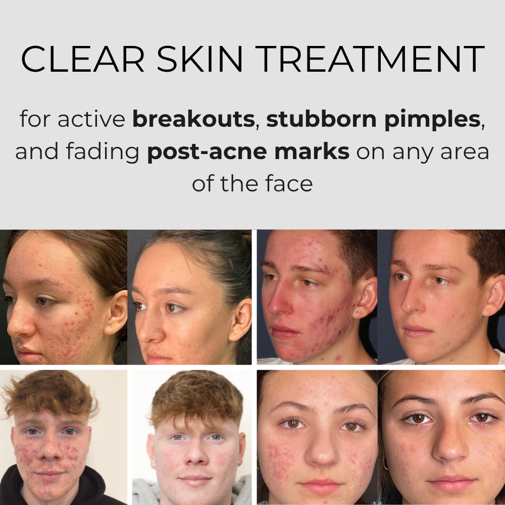 Theraloom Acne Mask 2.0